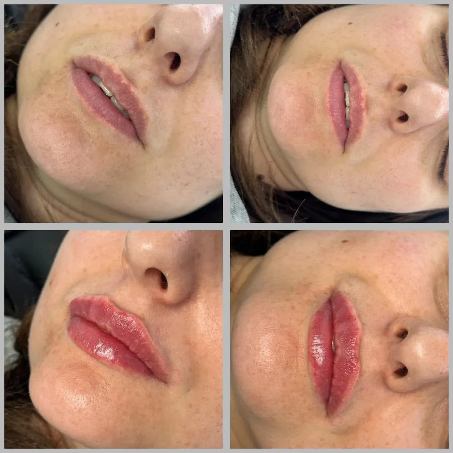 Lip Filler