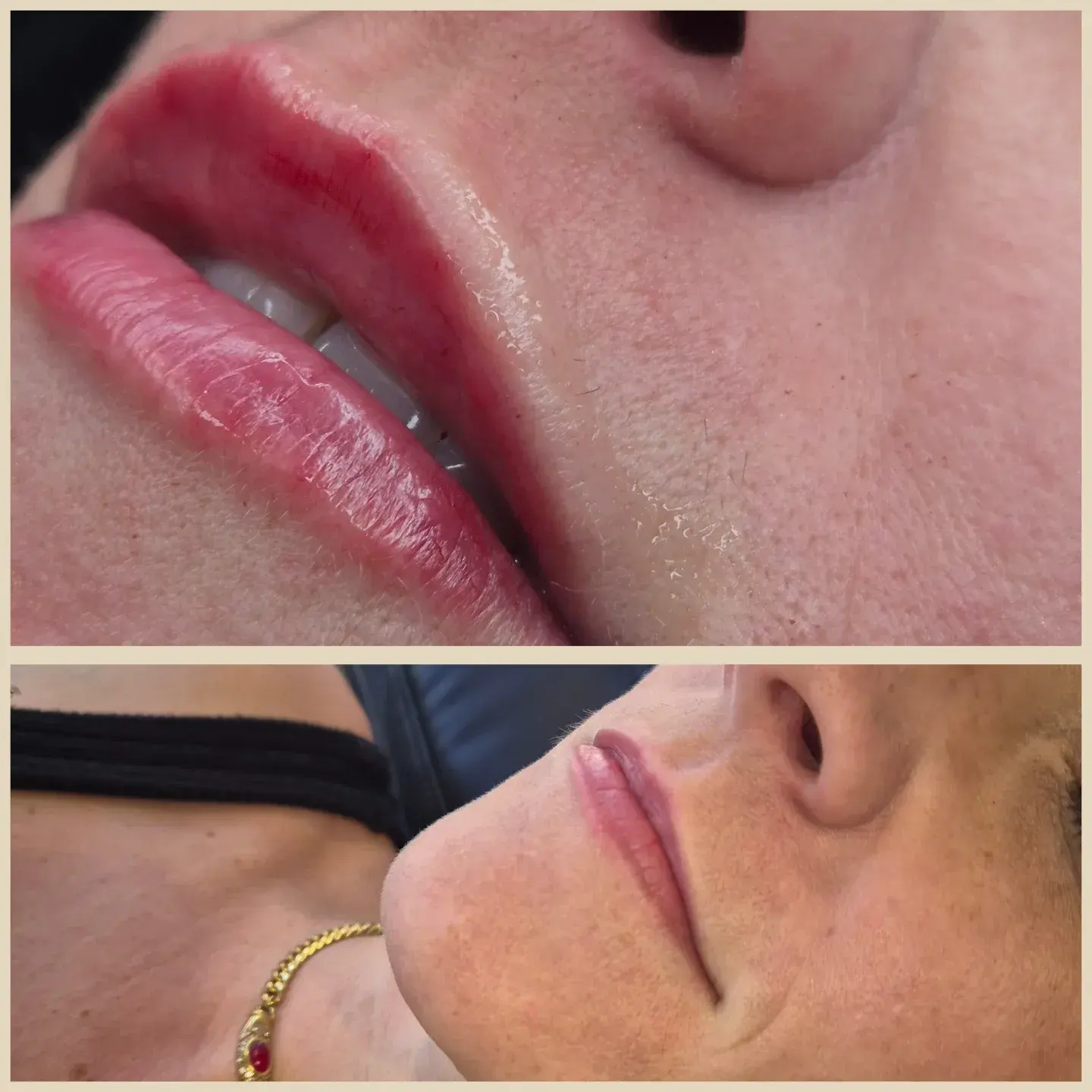 Lip Filler