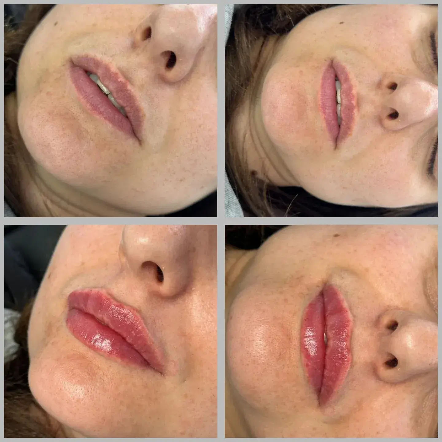 Lip Filler